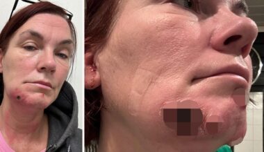 Åza, 49, smittad av kokoppor av sin katt