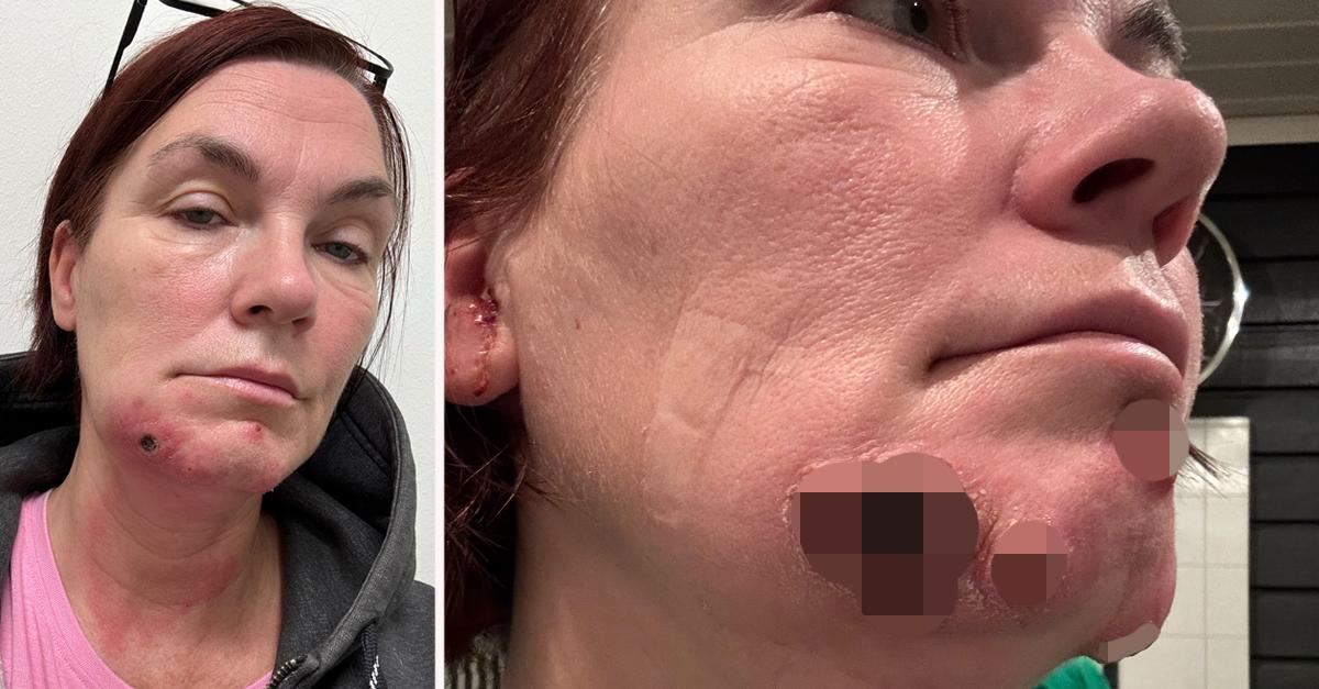 Åza, 49, smittad av kokoppor av sin katt