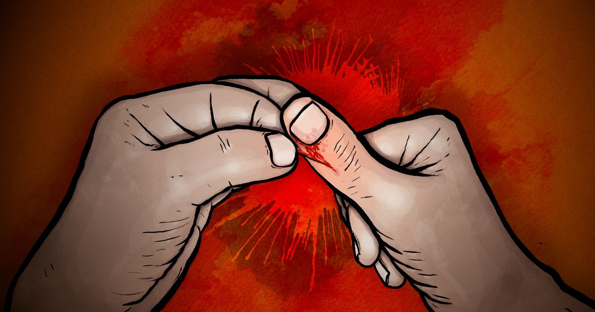 Dermatillomani, skin picking disorder, drabbar främst kvinnor – självhjälpstips