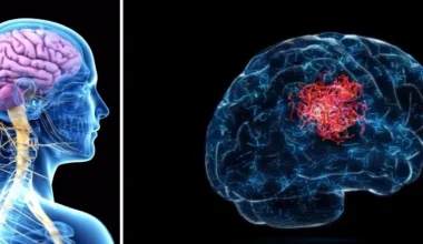 Var fjärde person riskerar att drabbas av stroke