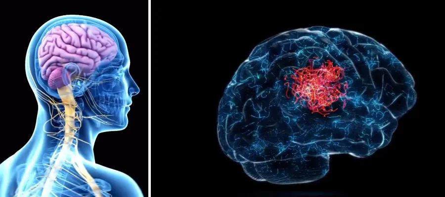 Var fjärde person riskerar att drabbas av stroke