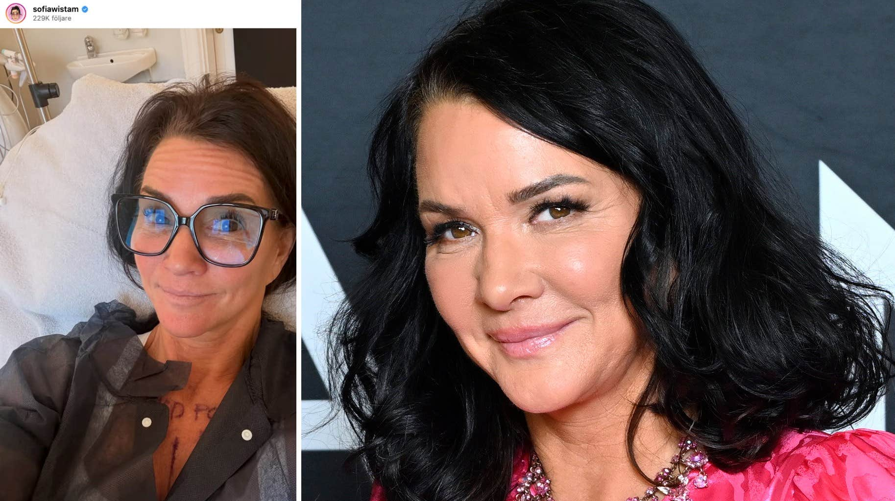 Sofia Wistam har gjort en bröstoperation efter bröstcancern