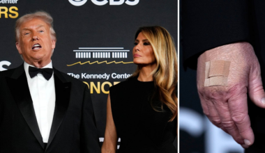 Svaret om Trumps mystiska plåster: Blåmärke efter handskakning | Världen