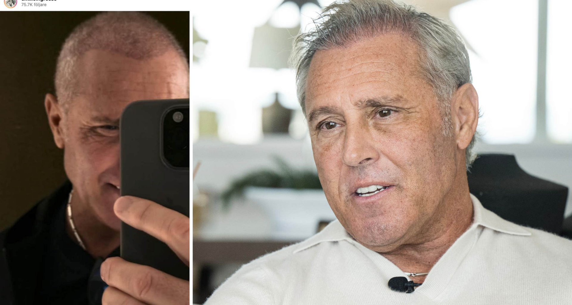 Emilio Ingrossos ord om nya hårtransplantationen i Turkiet