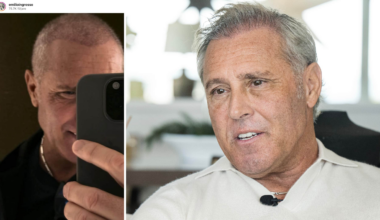 Emilio Ingrossos ord om nya hårtransplantationen i Turkiet