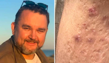 Stig-Ivan led av smärtsamma bölder, hidradenitis suppurativa