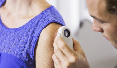 Lägre dos av immunterapi vid hudcancer ger bättre effekt