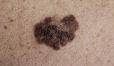 Bättre effekt av lägre dos immunterapi mot melanom