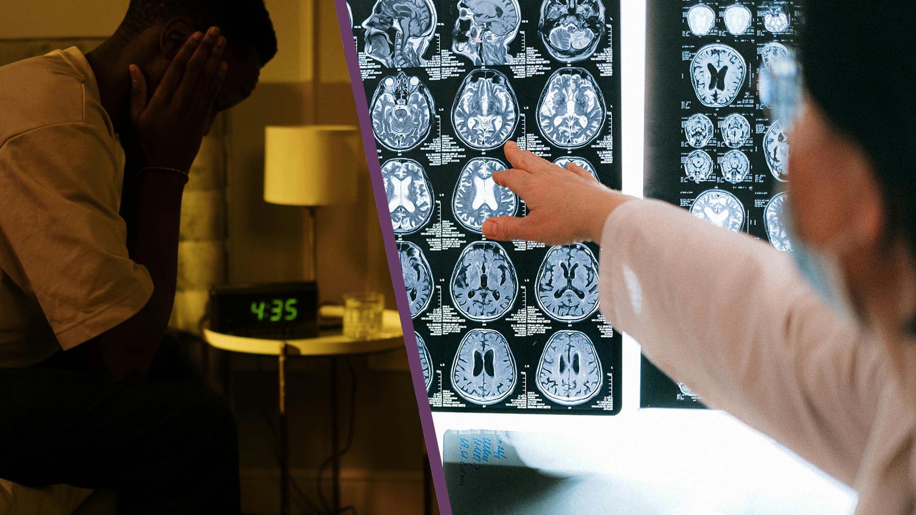 Dålig sömn kan få hjärnan att åldras snabbare.