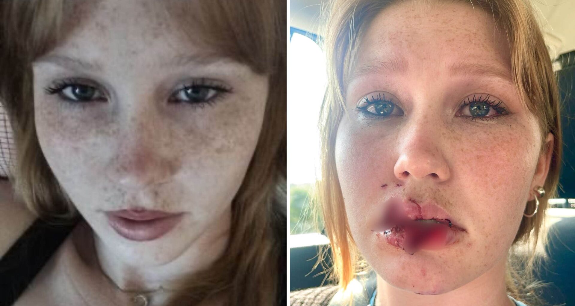 Ewelina Svenson skadad i hundattack i Norrköping