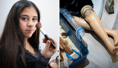 Gabriella Eser från Södertälje tvingades amputera benen efter sepsis