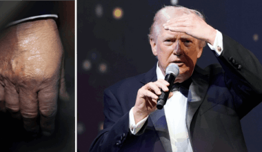 Trump skippar läkarnas råd – skyller märken på Aspirin