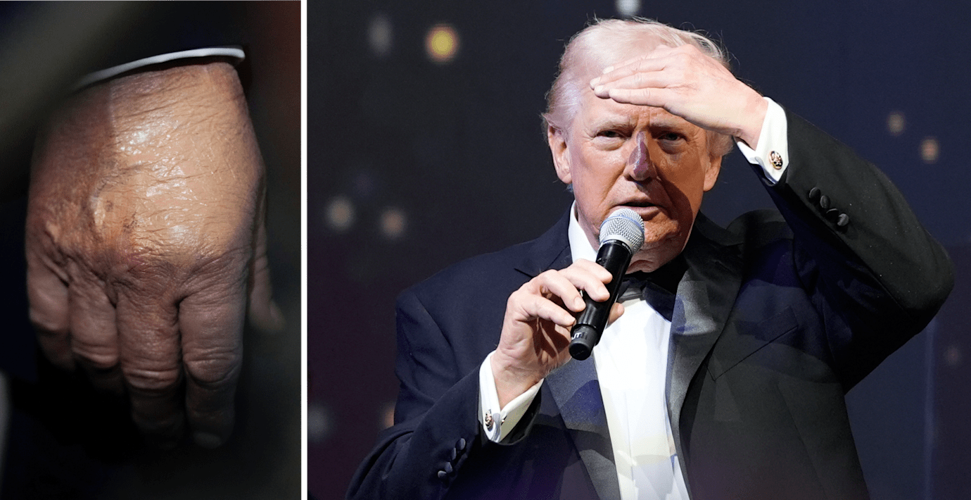 Trump skippar läkarnas råd – skyller märken på Aspirin