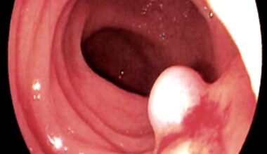 Toxin från bakterie kan motverka tillväxt av kolorektalcancer