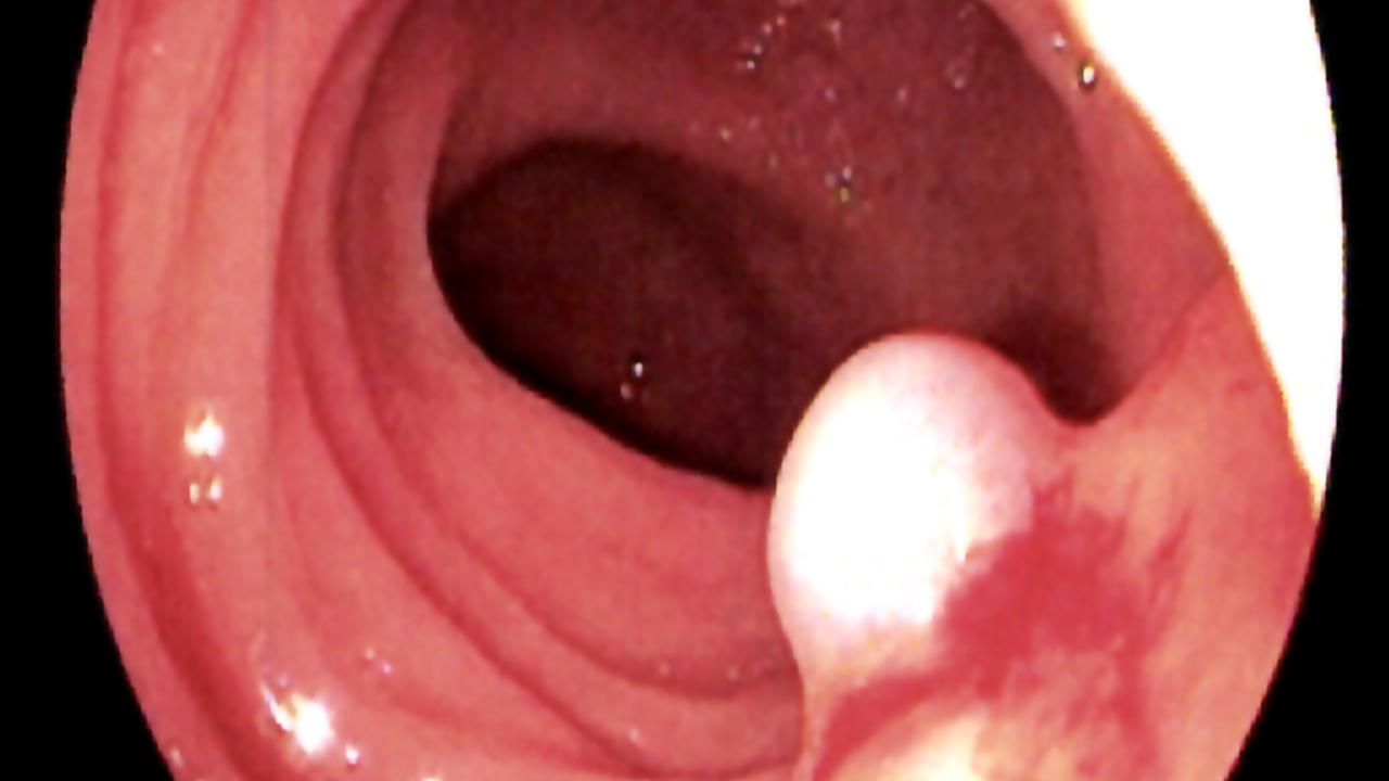 Toxin från bakterie kan motverka tillväxt av kolorektalcancer