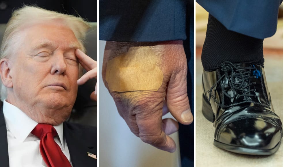 Trumps mystiska skada: Blödde efter en highfive