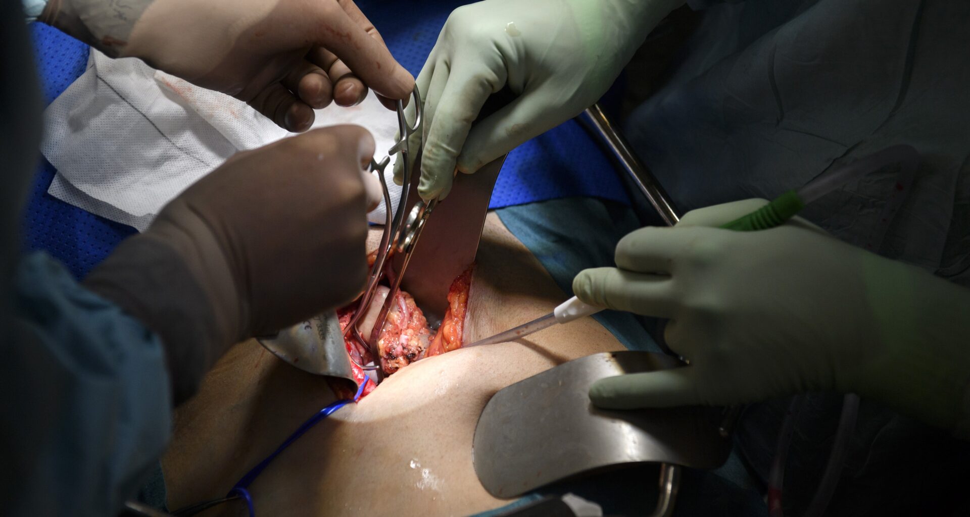 Minskande organdonationer skapar längre väntetider i Sverige