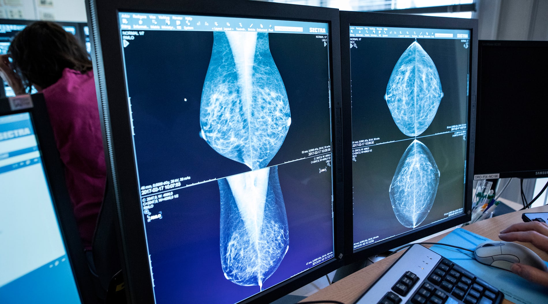En läkare tittar på mammografibilder.