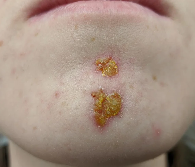 Impetigo prepoznamo po pojavu mehurčkov in krast medene barve na koži. FOTO: James Heilman, MD/Wikimedia Commons, CC BY-SA 4.0