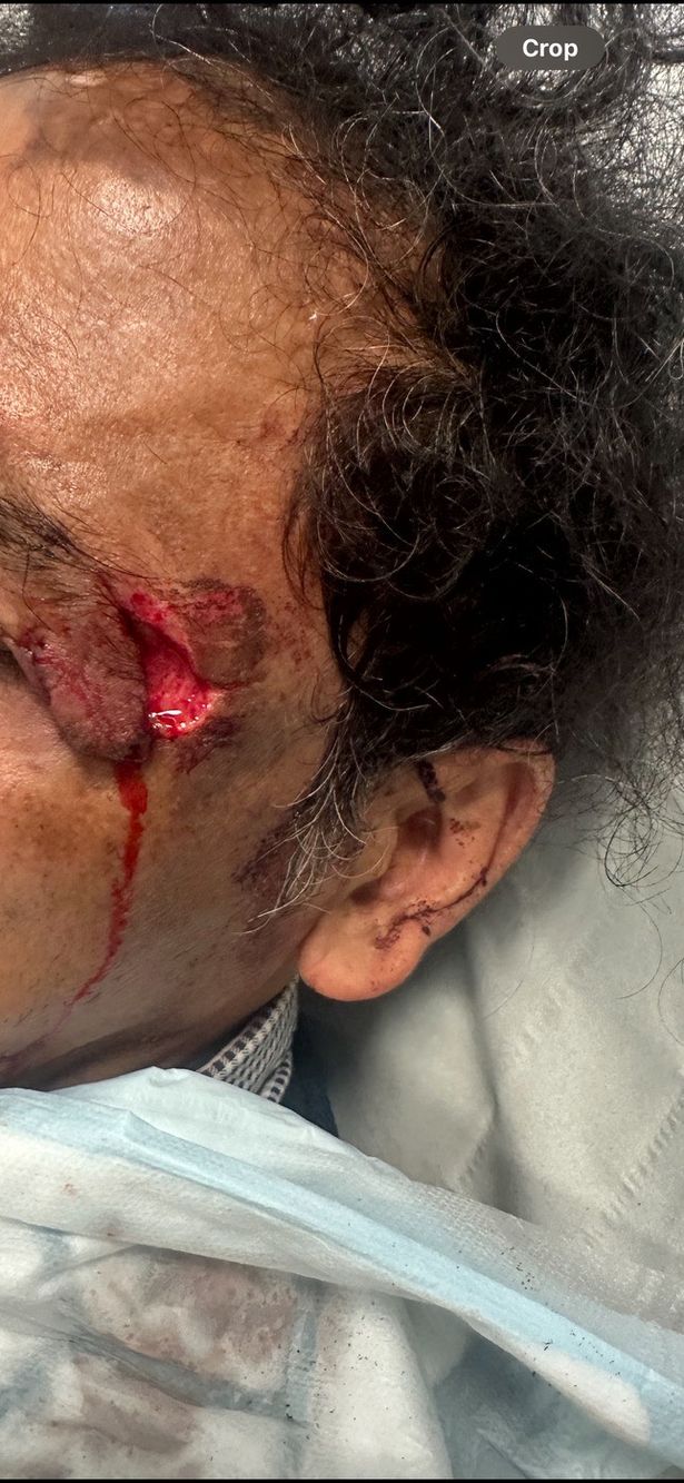 Injuries an employee at Target Food Store in Netherton sustained after a man bit his face