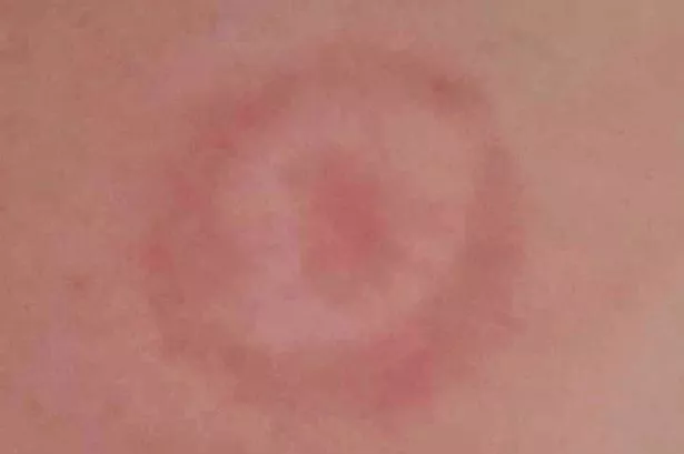 The UKHSA has shared the importance of regularly checking for ticks 