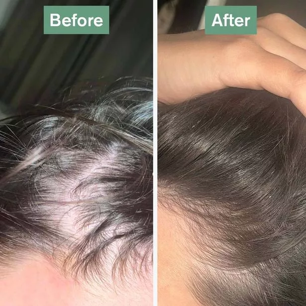 Before and after hair growth results