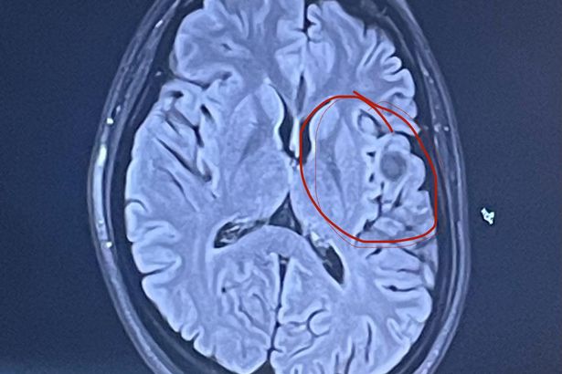 Hannah-Ireland Durando's brain scan revealed a golf-ball-sized growth on the left frontal lobe