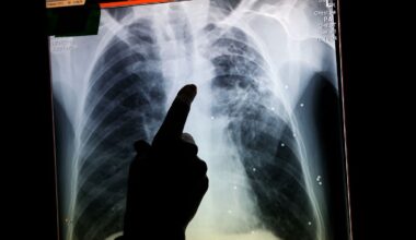 Why is tuberculosis, the world's deadliest infectious disease, on the rise in the UK?