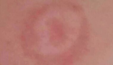 Warning issued over uncommon disease as weather gets warmer