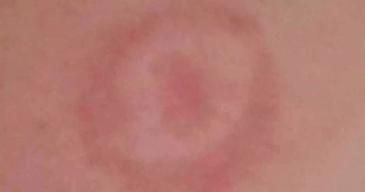Warning issued over uncommon disease as weather gets warmer