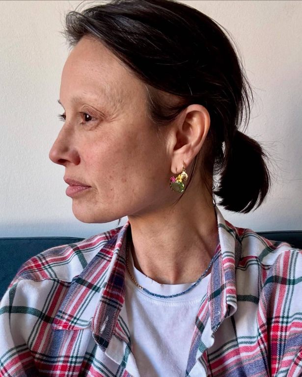 Side profile of Melanie showing her bald spot