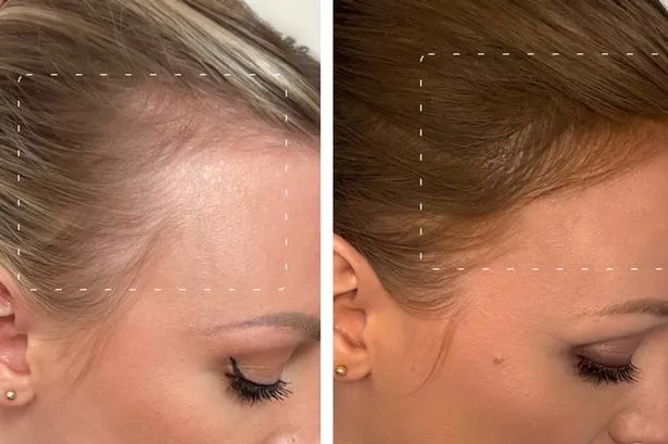 before and after taking hair growth supplements