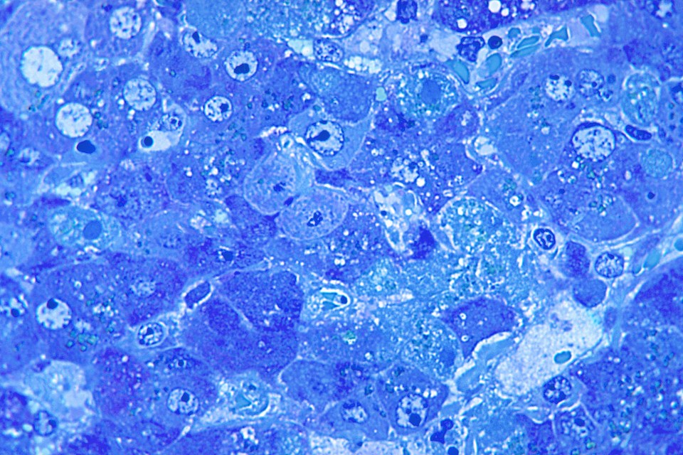 Photomicrograph of Lassa virus-caused hepatitis.