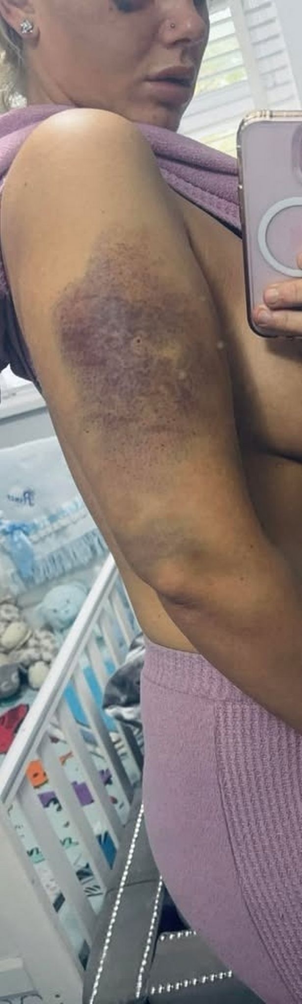 Huge bruises were left on Nicole's arm