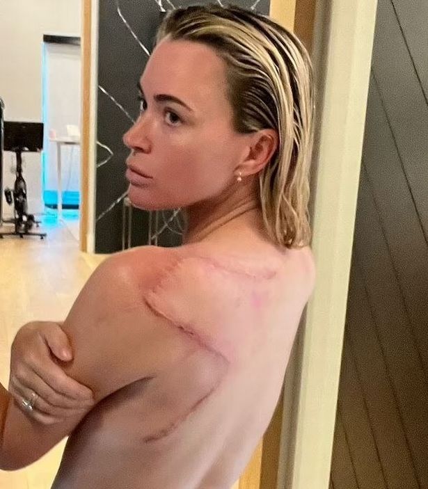 Teddi Mellencamp shows back scars from surgery