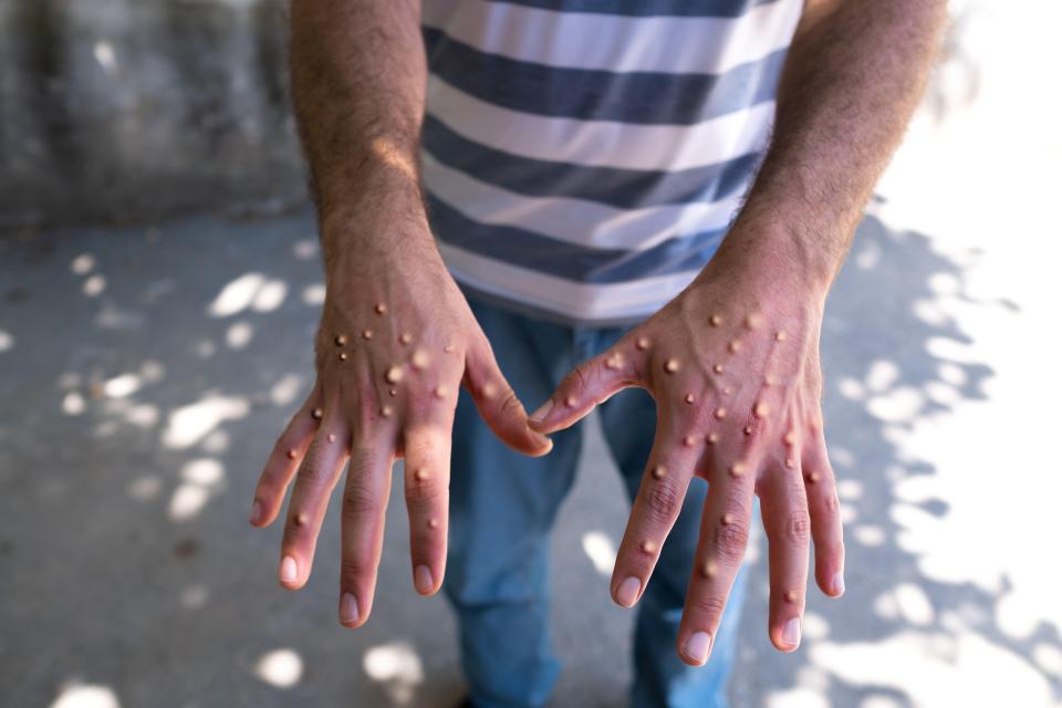 Close-up of hands with monkeypox lesions.