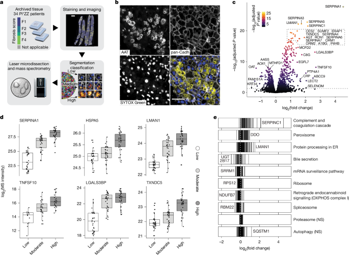 Deep Visual Proteomics maps proteotoxicity in a genetic liver disease
