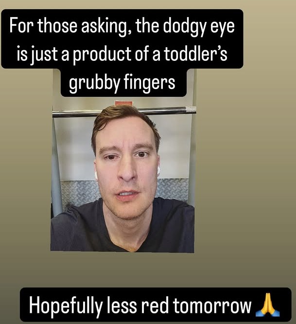 Man's red eye, caused by a toddler.