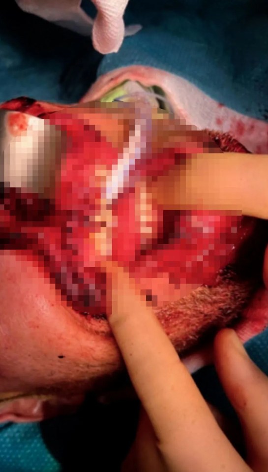 Close-up of Freddie Flintoff's facial injury.