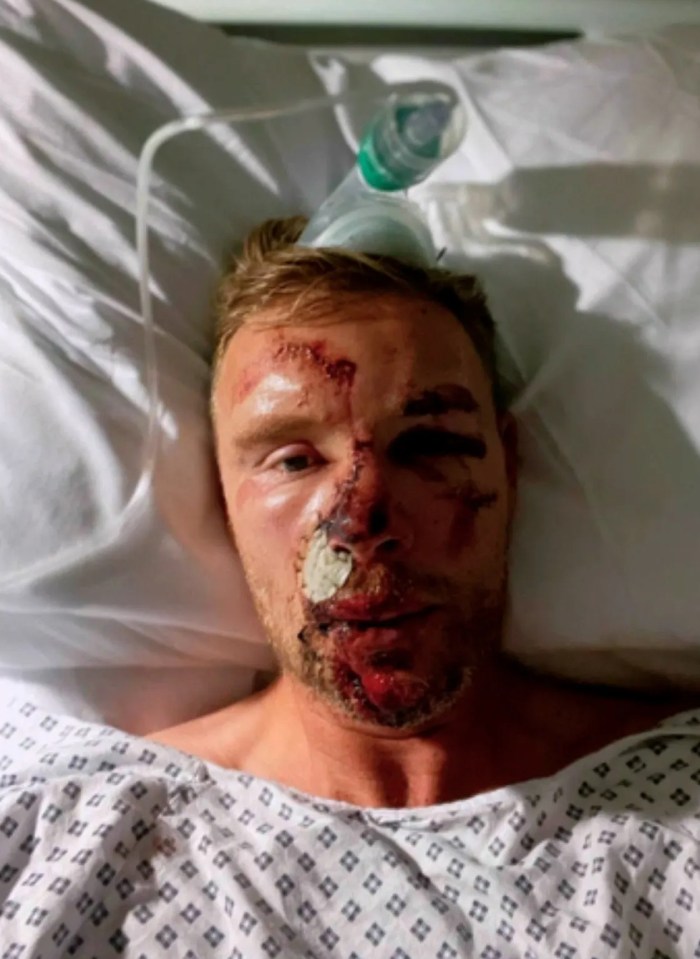 Freddie Flintoff with facial injuries in a hospital bed.