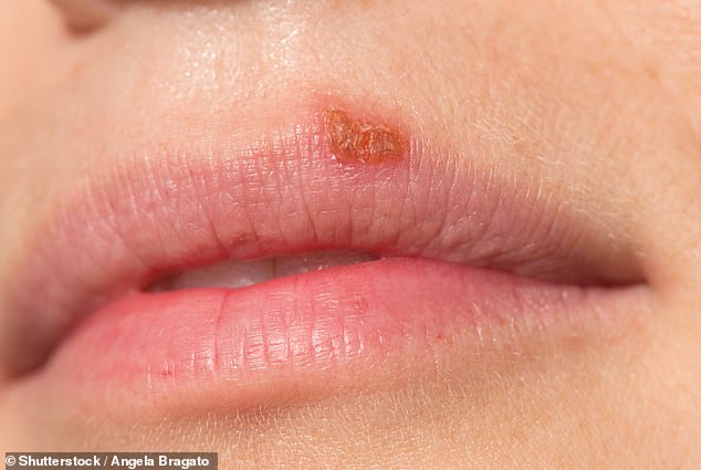 Both herpes simplex virus types one and two can cause genital herpes. Type one, which can occur at a young age, typically causes oral herpes (manifested as cold sores), while HSV-2 is generally associated with sexual transmission and genital herpes