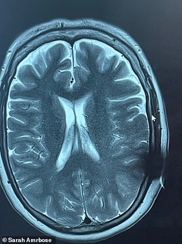 A scan provided by the grandmother of her brain. She has had several plastic shunts shatter in her skull due to pressure and accidents