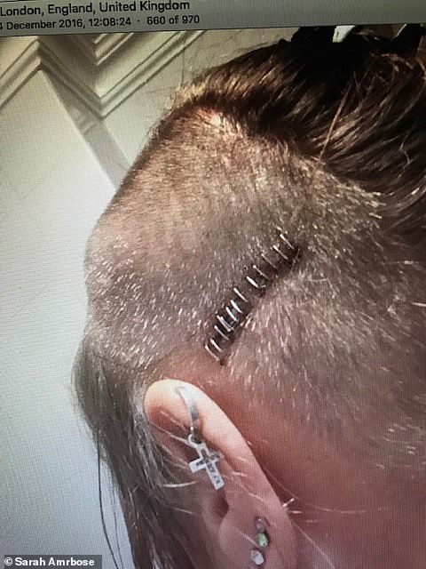 Pictured: Staples in Sarah's head after a procedure attempting to replace the shunts draining the CSF liquid