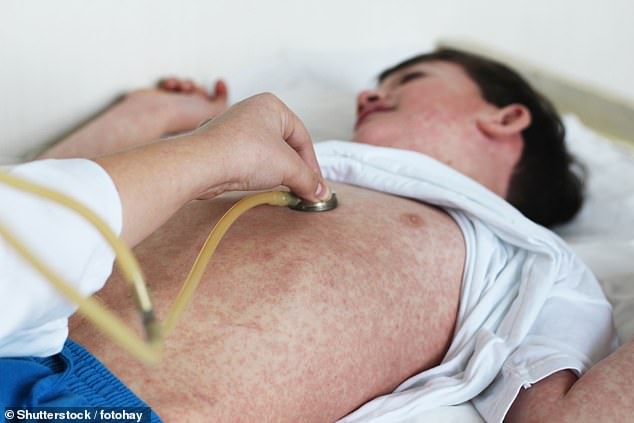 Initial measles symptoms include fever, runny nose, sore eyes and a cough followed by a red, blotchy rash (stock image)