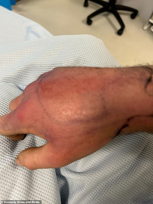 Brian's hand ballooned after he was bitten by the spider while he slept