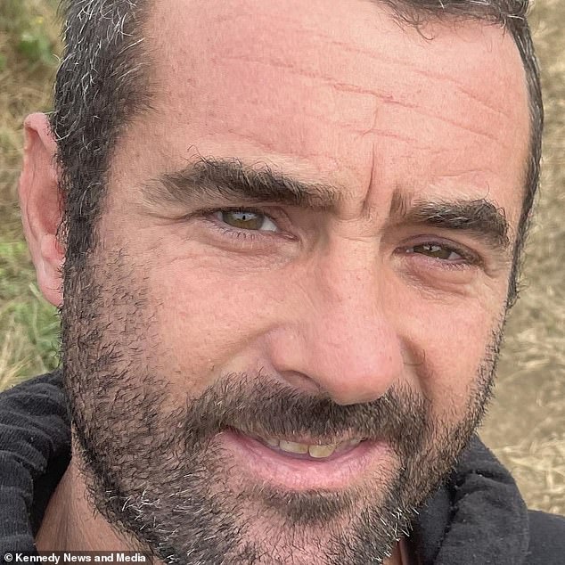 Brian Smith, 43, was forced to go to hospital after suffering a suspected false widow spider bite