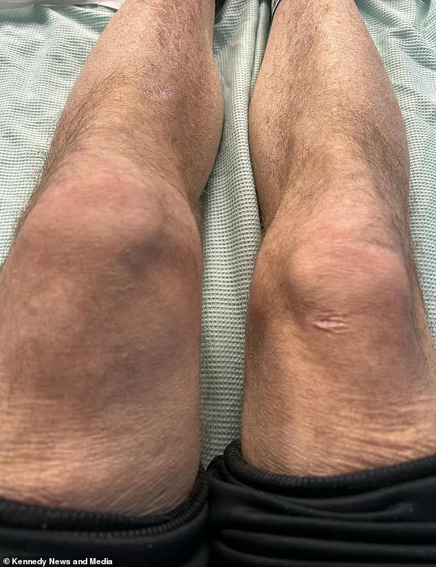 The scaffolder was forced to stay in hospital for three weeks as the venom spread to his legs and the rest of his body. Pictured is Brian's swollen knee after