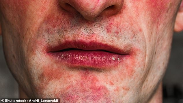 A zinc deficiency can lead to dermatitis, a skin condition that can cause inflammation, redness, and rashes, including around the mouth