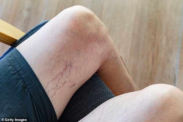 Dilated blood vessels on the chest, abdomen, face or ribs may tend to be one of the first signs of liver dysfunction