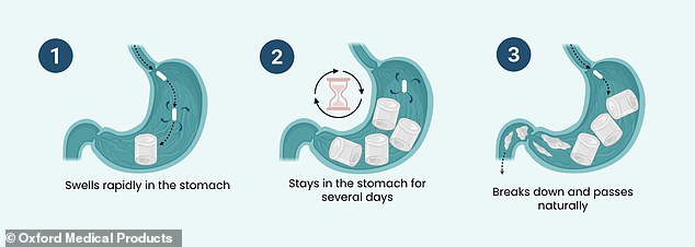 The capsule, which is taken first thing in the morning with a glass of water, absorbs the water and expands in the stomach within just 30 minutes. It is designed to make the patient feel fuller so, in theory, they eat less